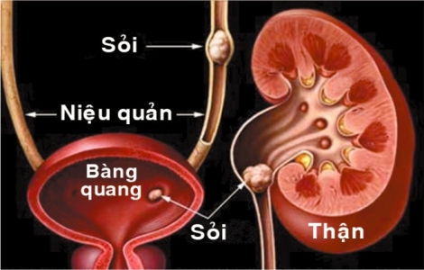 Bài thuốc tự chữa sỏi thận trong 7 ngày vô cùng hiệu quả