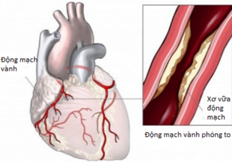 Bệnh mạch vành có thể dẫn đến các cơn nhồi máu cơ tim nguy hiểm